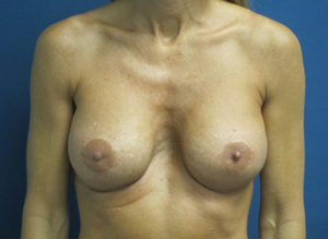 Breast Revision Before and After Pictures St. Louis, MO