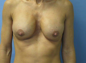 Breast Revision Before and After Pictures St. Louis, MO