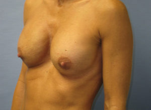 Breast Revision Before and After Pictures St. Louis, MO