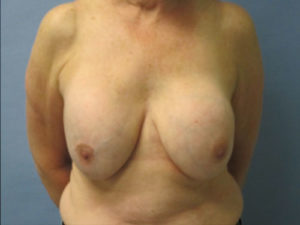 Implant Removal Before and After Pictures in St. Louis, MO