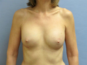 Breast Augmentation Before and After Pictures in St. Louis, MO