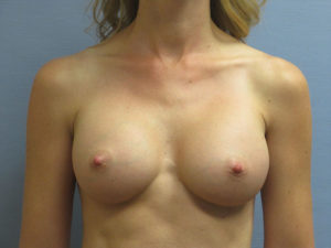 Breast Augmentation Before and After Pictures in St. Louis, MO