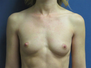 Breast Augmentation Before and After Pictures in St. Louis, MO