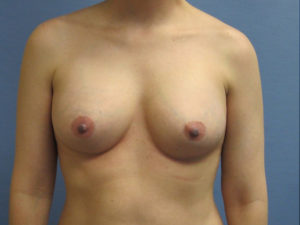 Breast Augmentation Before and After Pictures in St. Louis, MO