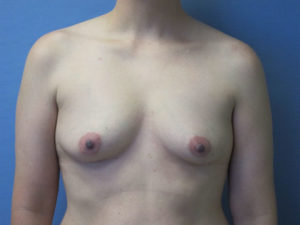 Breast Augmentation Before and After Pictures in St. Louis, MO