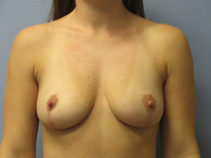 Breast Reduction Before and After Pictures in St. Louis, MO