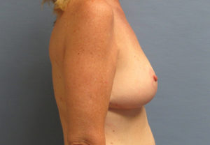 Breast Reduction Before and After Pictures in St. Louis, MO