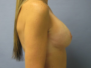 Breast Revision Before and After Pictures in St. Louis, MO