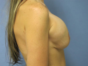 Breast Revision Before and After Pictures in St. Louis, MO