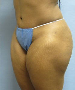 Tummy Tuck Before and After Pictures in St. Louis, MO