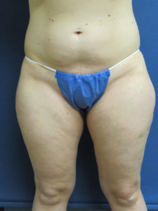 Liposuction Before and After Pictures St. Louis, MO