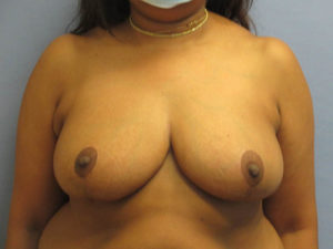 Breast Reduction Before and After Pictures in St. Louis, MO