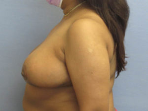 Breast Reduction Before and After Pictures in St. Louis, MO