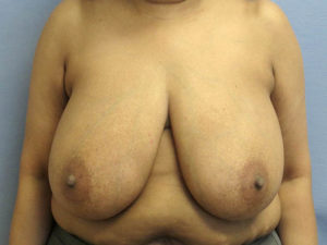 Breast Reduction Before and After Pictures in St. Louis, MO