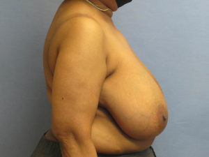 Breast Reduction Before and After Pictures in St. Louis, MO