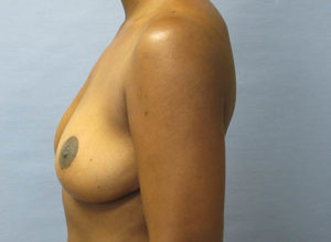 Breast Lift Before and After Pictures St. Louis, MO