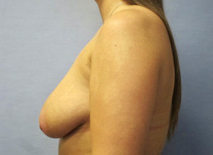 Breast Lift Before and After Pictures St. Louis, MO