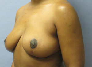 Breast Lift Before and After Pictures St. Louis, MO