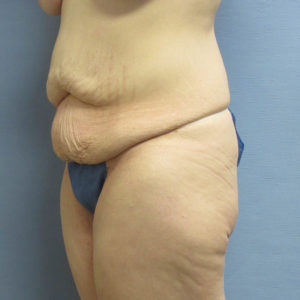 Tummy Tuck Before and After Pictures in St. Louis, MO