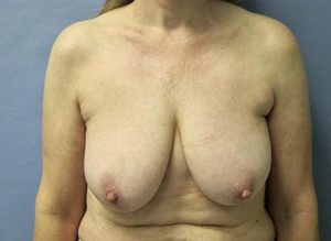 Breast Lift Before and After Pictures St. Louis, MO