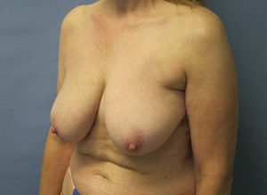 Breast Lift Before and After Pictures St. Louis, MO