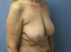 Breast Lift Before and After Pictures St. Louis, MO