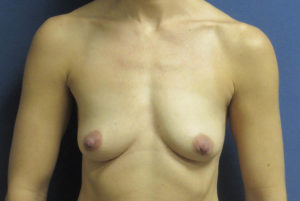 Breast Augmentation Before and After Pictures in St. Louis, MO