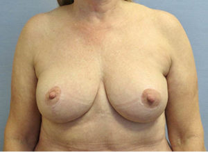 Breast Lift Before and After Pictures St. Louis, MO