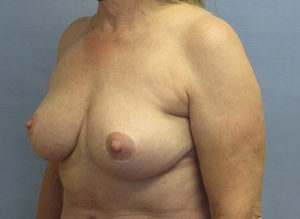 Breast Lift Before and After Pictures St. Louis, MO