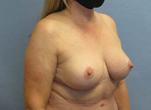 Breast Lift Before and After Pictures St. Louis, MO