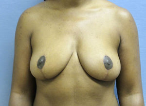 Breast Lift Before and After Pictures St. Louis, MO