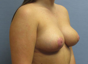 Breast Lift Before and After Pictures St. Louis, MO