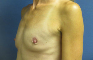 Breast Augmentation Before and After Pictures in St. Louis, MO