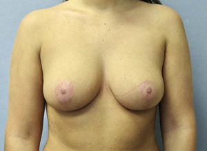 Breast Lift Before and After Pictures St. Louis, MO