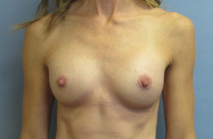 Breast Augmentation Before and After Pictures in St. Louis, MO