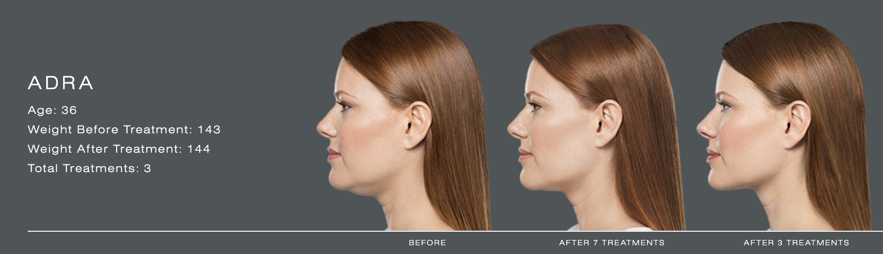 Kybella in St. Louis, MO