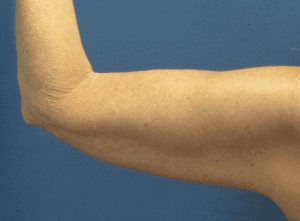 CoolSculpting® Before and After Pictures St. Louis, MO