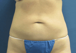 CoolSculpting® Before and After Pictures St. Louis, MO
