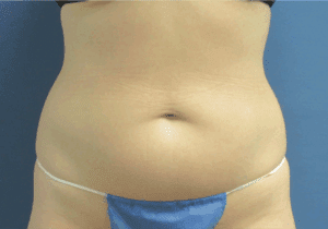 CoolSculpting® Before and After Pictures St. Louis, MO