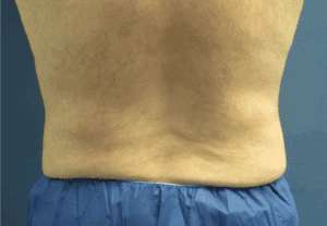 CoolSculpting® Before and After Pictures St. Louis, MO
