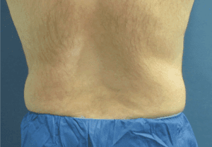 CoolSculpting® Before and After Pictures St. Louis, MO